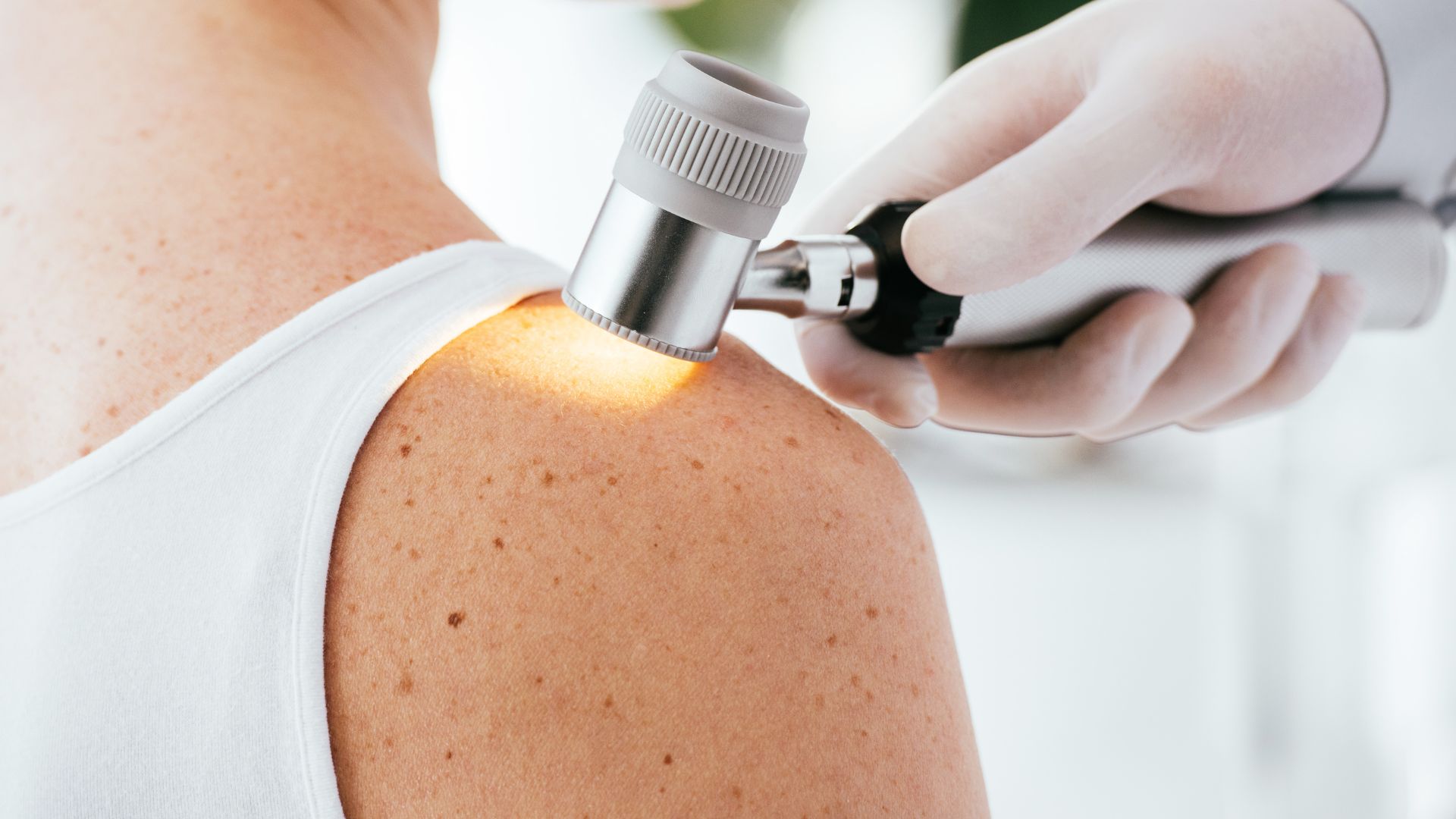 Redni dermatološki pregledi kože so ključnega pomena za zgodnje odkrivanje kožnega raka.